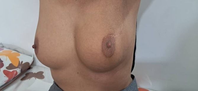 جراحی انکوپلاستی در حفظ زیبایی سینه سمت چپ