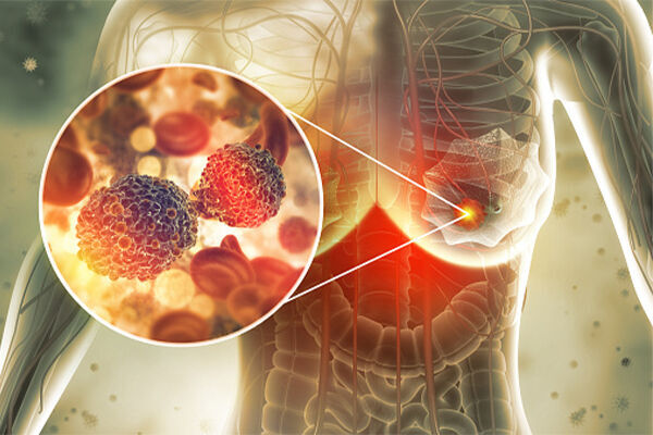 سرطان سینه چیست؟